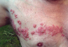 โบราณว่าไว้ งูสวัดขึ้นรอบตัวจะเสียชีวิต จริงหรือไม่