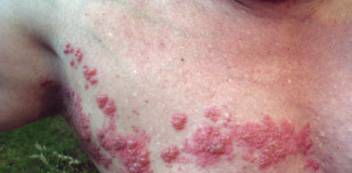 โบราณว่าไว้ งูสวัดขึ้นรอบตัวจะเสียชีวิต จริงหรือไม่